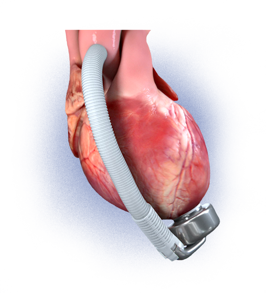 CorWave LVAD CorWave EN
